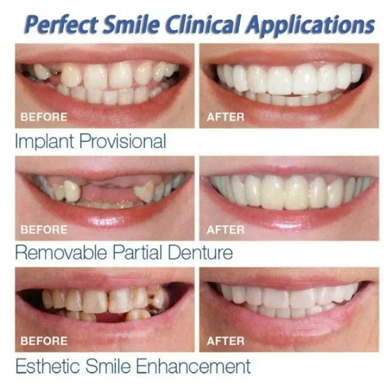 Set Veneer Gigi yang Dapat Dip - Teeth Whitening Kit ulasan dan harga